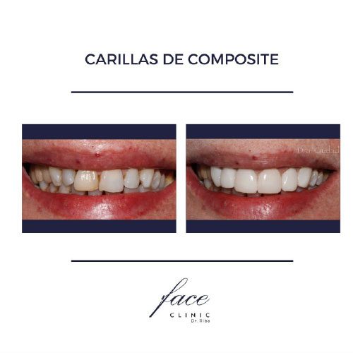 Carillas dentales antes y después en Huelva - Caso 6